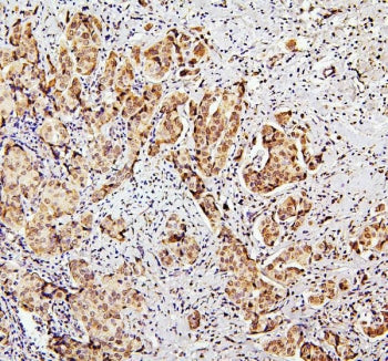 IHC staining of FFPE human breast cancer with SUZ12 antibody. HIER: boil tissue sections in pH6, 10m