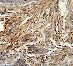 IHC testing of FFPE human lung carcinoma tissue with CSF2 antibody. HIER: steam section in pH6 citra