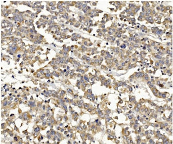 IHC staining of FFPE human breast cancer with PI3K gamma antibody. HIER: boil tissue sections in pH8