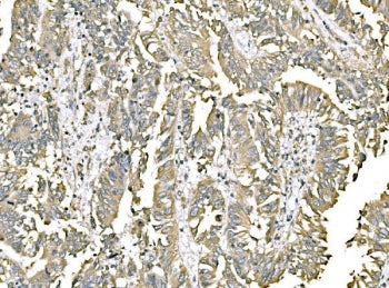 IHC staining of FFPE human rectal cancer tissue with ERp57 antibody. HIER: boil tissue sections in p