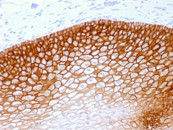 IHC testing of FFPE human cervical squamos cell carcinoma with recombinant CD44v4 antibody (clone rC