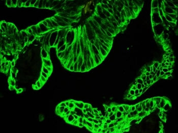 Immunofluorescent staining of FFPE human intestinal cancer with pan Cytokeratin antibody. HIER: stea