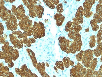 IHC staining of FFPE human basal cell carcinoma with Cytokeratin 5/6 antibody (clone KRT5.6/2090). H