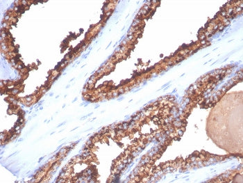 IHC staining of FFPE human prostate cancer tissue with CD26 antibody (clone DPP4/7415). HIER: boil t