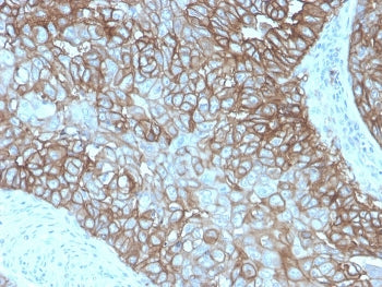 IHC staining of FFPE human breast carcinoma with recombinant PD-L1 antibody (clone rPDL1/4772). HIER