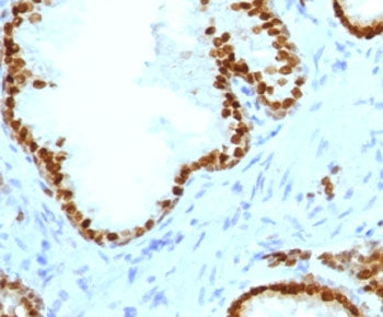 IHC staining of FFPE human prostate carcinoma with recombinant ATRX antibody (clone ATMRX-1R). HIER: