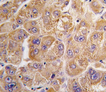 IHC testing of FFPE human hepatocellular carcinoma tissue with IDE antibody. HIER: steam section in 