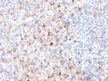 IHC: Formalin-fixed, paraffin-embedded human melanoma stained with recombinant Tyrosinase antibody (