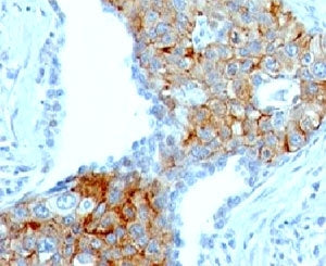 IHC: Formalin-fixed, paraffin-embedded human lung squamous cell carcinoma stained with TRIM29 antibo