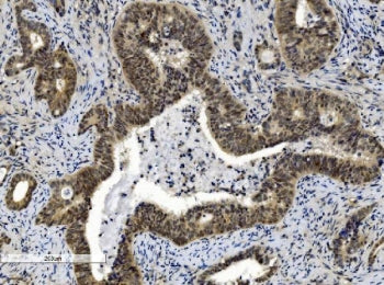 IHC staining of FFPE human gallbladder adenocarcinoma tissue with CBX8 antibody. HIER: boil tissue s
