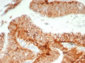 IHC staining of FFPE human colon carcinoma tissue with CD147 antibody (clone BSG/7954) at 2ug/ml. HI
