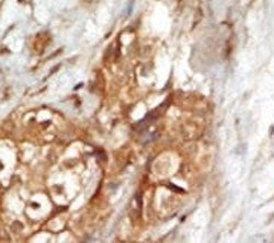 IHC analysis of FFPE human breast carcinoma tissue stained with the NIK antibody