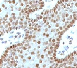 IHC testing of FFPE human cervical carcinoma and c-Myc antibody (clone MVH39-1). Staining of formali
