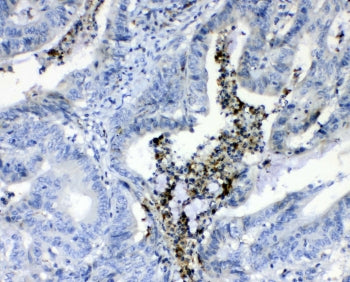 IHC testing of FFPE human colon cancer tissue with Prothrombin antibody at 1ug/ml. Required HIER: st