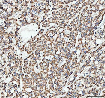 IHC staining of FFPE human liver cancer tissue with ATG7 antibody. HIER: boil tissue sections in pH8