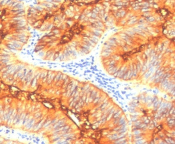 IHC testing of FFPE human colon carcinoma with Mucin 4 antibody (clone MUCN4-1). HIER: requires stea