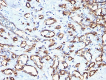 IHC staining of FFPE human angiosarcoma with CD34 antibody. HIER: boil tissue sections in pH 9 10mM 
