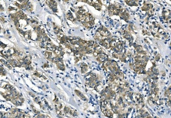 IHC staining of FFPE human breast cancer with ASS1 antibody. HIER: boil tissue sections in pH8 EDTA 