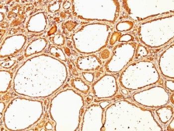 IHC: Formalin-fixed, paraffin-embedded human thyroid carcinoma stained with anti-TG antibody (SPM517