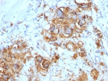 IHC: Formalin-fixed, paraffin-embedded human gastric carcinoma stained with CA19-9 antibody (121SLE)