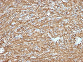 IHC testing of FFPE human gastrointestinal stromal tumor (GIST) with TMEM16A antibody (clone DG1/283
