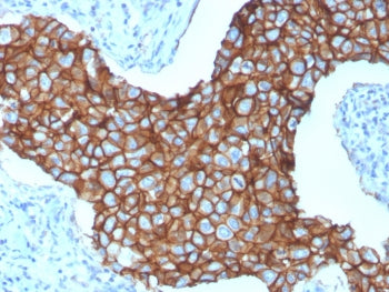 IHC staining of FFPE human breast cancer with HER-2 antibody (clone ERBB2/3257). HIER: boil tissue s