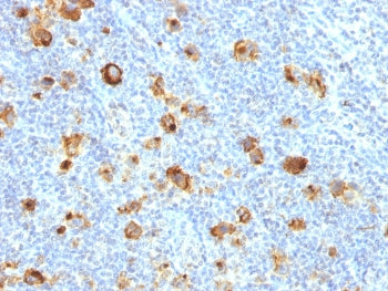 IHC testing of FFPE human Hodgkin's lymphoma and recombinant CD15 antibody (clone FUT4/1478R). Requi