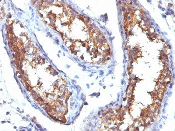 IHC: Formalin-fixed, paraffin-embedded human testicular carcinoma stained with CD99 antibody (HO36-1