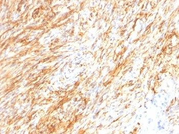 IHC: Formalin-fixed, paraffin-embedded human Schwanoma stained with GFAP antibody cocktail (GA-5 + A
