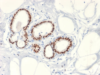IHC testing of FFPE human breast cancer with Estrogen Receptor antibody (clone ESR1/2299R). Required