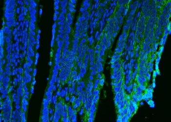 Immunofluorescent staining of FFPE human intestinal cancer tissue with CD9 antibody (green) and DAPI