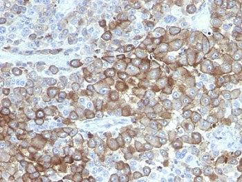IHC anlaylsis of formalin-fixed, paraffin-embedded human melanoma stained with Melanoma antibody (cl