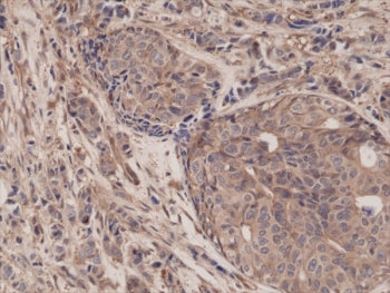 IHC testing of FFPE human breast cancer tissue with recombinant p65 antibody at 1:1250.