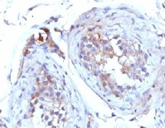IHC testing of FFPE human testicular carcinoma with SHBG antibody (clone TTEB3). Staining of formali