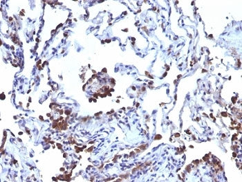 IHC: Formalin-fixed, paraffin-embedded human melanoma metastasized to lung stained with CD63 antibod
