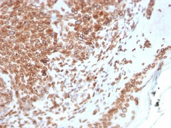 IHC testing of FFPE human basal cell carcinoma with Emerin antibody (clone EMD/2168). Required HIER: