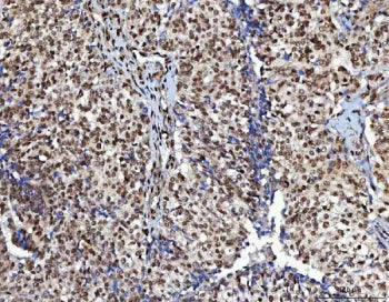 IHC staining of FFPE human ovarian cancer tissue with CML66 antibody. HIER: boil tissue sections in 