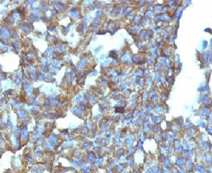 IHC: Formalin-fixed, paraffin-embedded human ovarian carcinoma stained with CD99 antibody (clone MIC