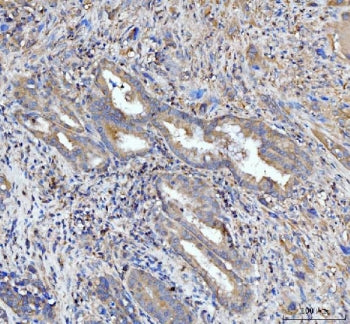IHC staining of FFPE human gall bladder adenosquamous carcinoma tissue with PDLIM7 antibody. HIER: b