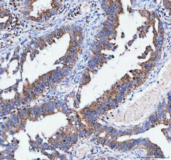 IHC staining of FFPE human rectum adenocarcinoma tissue with IARS2 antibody. HIER: boil tissue secti