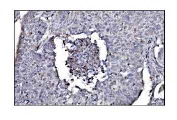 IHC staining of FFPE human lung cancer tissue with SLFN11 antibody. HIER: boil tissue sections in pH