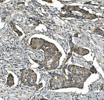 IHC staining of FFPE human breast cancer with STAT6 antibody. HIER: boil tissue sections in pH8 EDTA