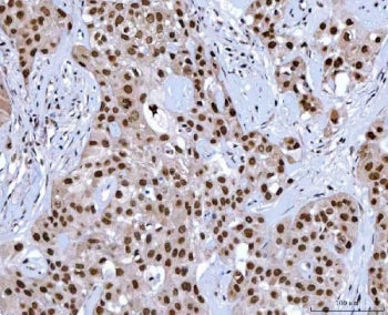 IHC staining of FFPE human acinic cell carcinoma tissue with NSUN2 antibody. HIER: boil tissue secti