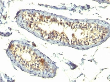 IHC: Formalin-fixed, paraffin-embedded human testicular carcinoma stained with TGF-alpha antibody (T