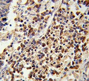 IHC testing of FFPE human lung carcinoma tissue with U2AF1 antibody. HIER: steam section in pH6 citr