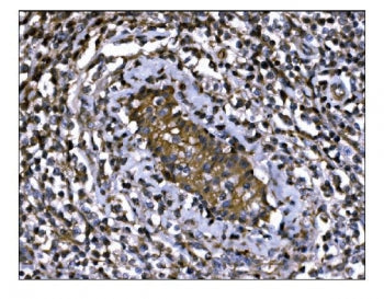 IHC staining of FFPE human gastric cancer tissue with M6PR antibody. HIER: boil tissue sections in p