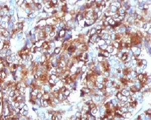 IHC testing of FFPE breast carcinoma and MUC-1 antibody (clone MCN01-1).