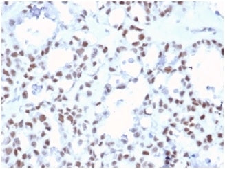 IHC staining of FFPE human ovarian carcinoma tissue with MLH1 antibody (clone MLH1/6467). HIER: boil