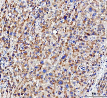 IHC staining of FFPE human liver cancer tissue with NUDT6 antibody. HIER: boil tissue sections in pH