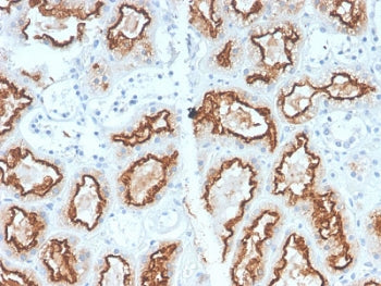 IHC staining of FFPE human renal cell carcinoma with recombinant Carbonic Anhydrase 9 antibody (clon